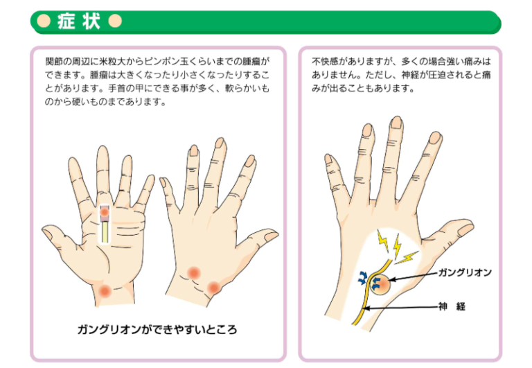 ガングリオンの治療について | クリニックの特徴 | 長府みらいクリニック