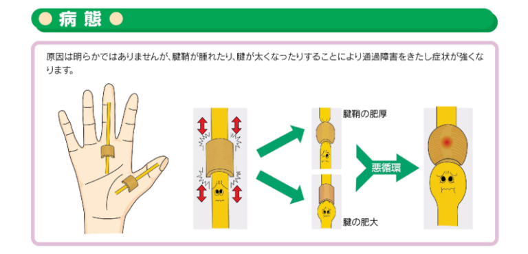 ばね指の治療・手術について | 当クリニックの特徴 | 長府みらいクリニック